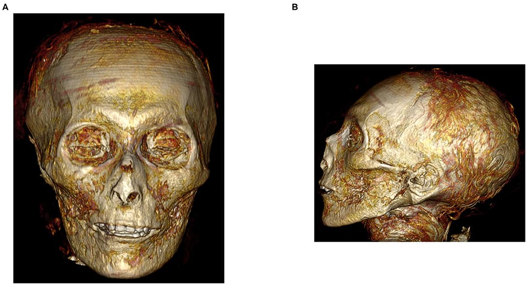 Front and side views of the skull of Egyptian Pharaoh Amenhotep 1 revealed via CT scanning